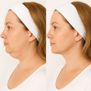 Criolipólisis papada